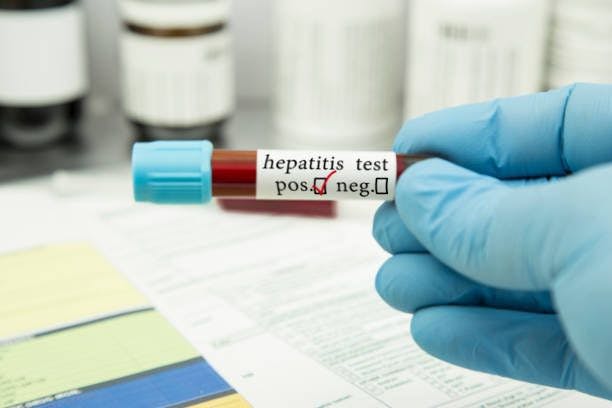 Hepatitis test

Image credits: Unsplash