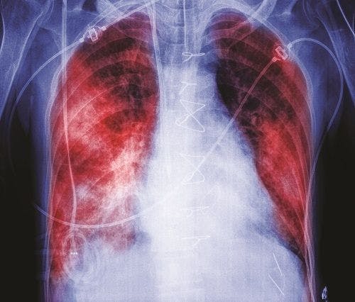 New Prediction Model Assesses the Risk for Acute Respiratory Distress Syndrome in Burn Patients