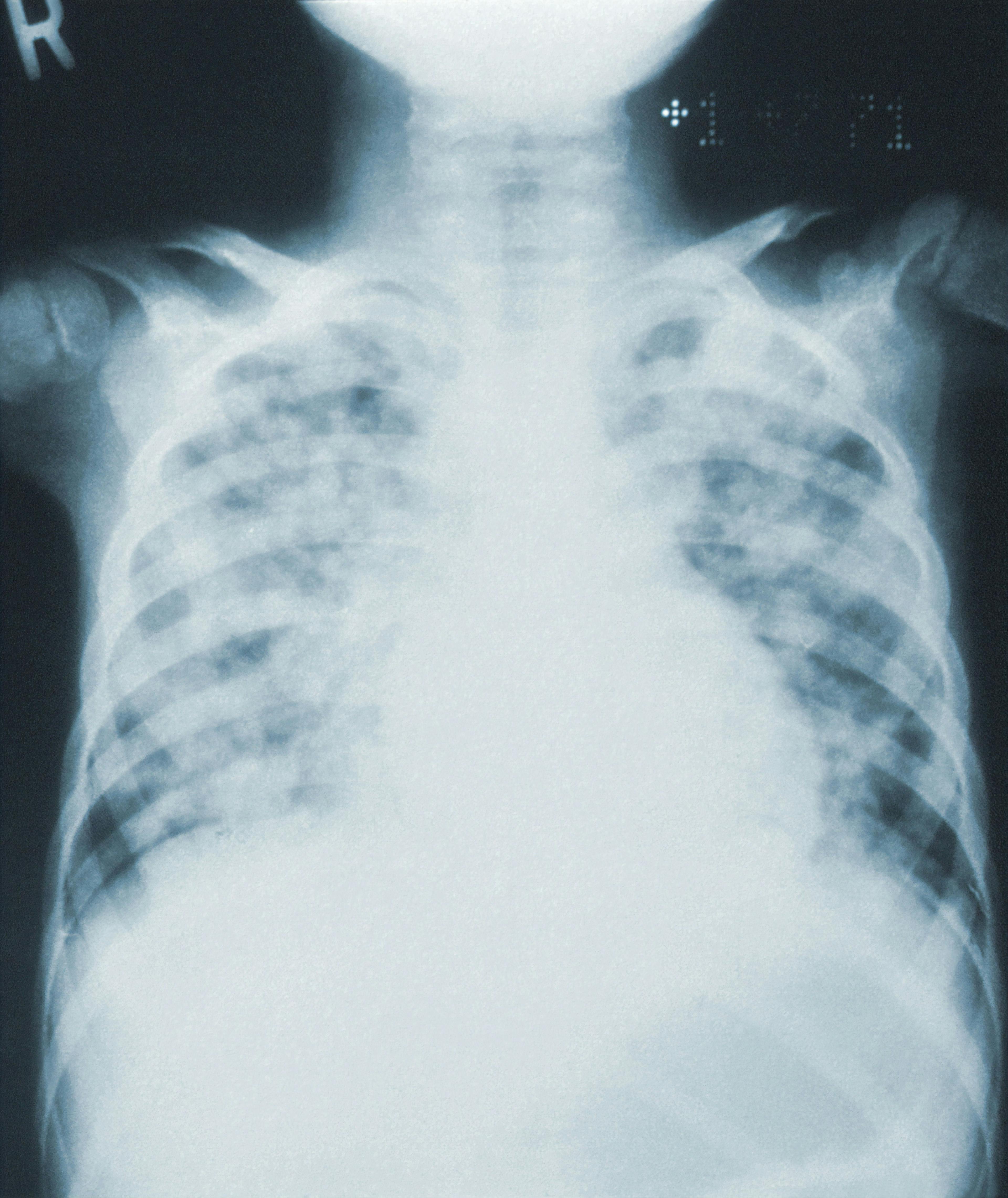 Community Acquired Pneumonia Often Inappropriately Diagnosed in Hospital Admissions