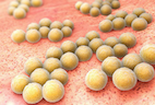 Atopic Dermatitis Increases Risk of Staph Colonization