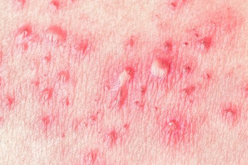 Herpes Zoster Complication in Vaccinated 19-Year-Old Linked to Corticosteroid Treatment