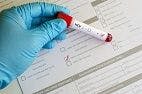 Hepatitis C Testing Is Lacking in High-Risk Patients with HIV