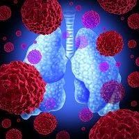 HMPV Pneumonia Associated with Older Age, Cigarette Use, Underlying Disease
