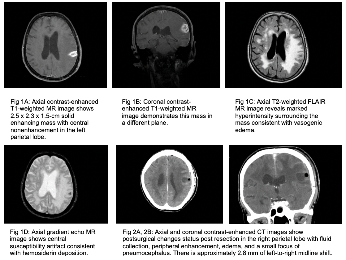 A Case of CNS Nocardia farcinica Presenting as Aphasia in an ...