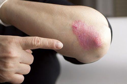 Study Finds No Significant Correlation Between Psoriasis and Prevalence of HBV and HCV