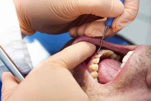 Severe Gum Disease Leads to Higher Risk of Cancer