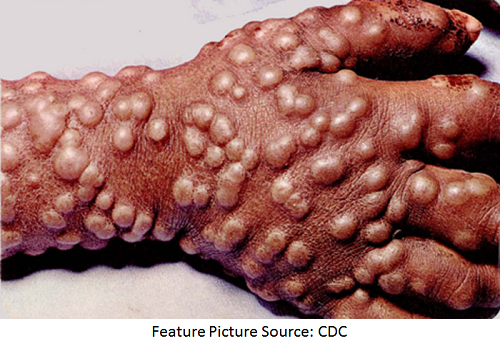 Smallpox Treatment Moves Closer to FDA Approval