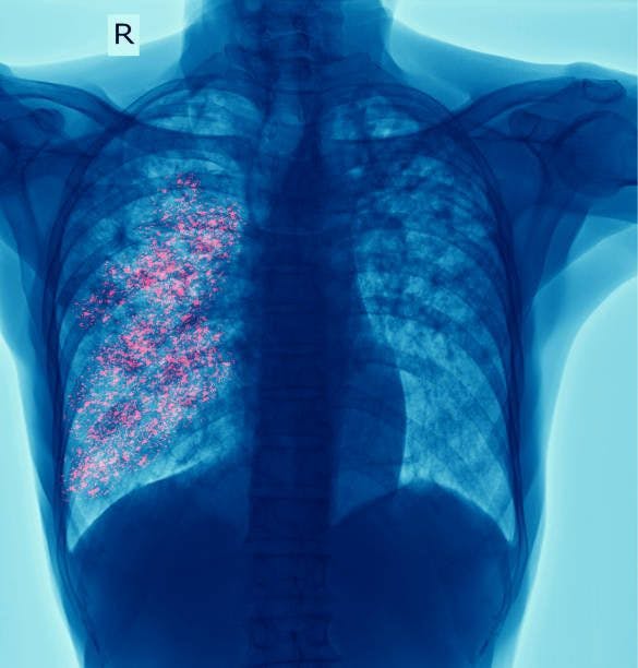 Chest x-ray showing cavity at right lung and interstitial infiltrate both lung due to Tuberculosis infection.

Image credits: Unsplash