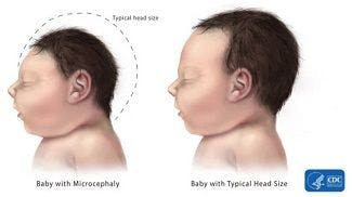 Infectious Cause of Microcephaly May Not be Zika