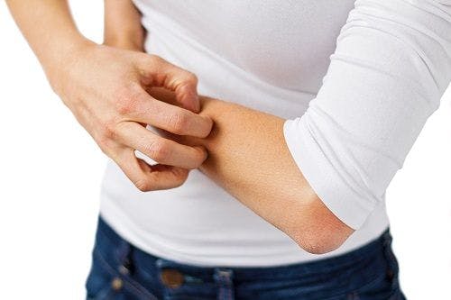 Eczema Could Compromise Flu Shots