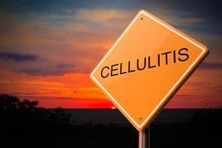 Can Outpatient Oritavancin Therapy Prevent Hospital Admissions for Patients With Cellulitis?