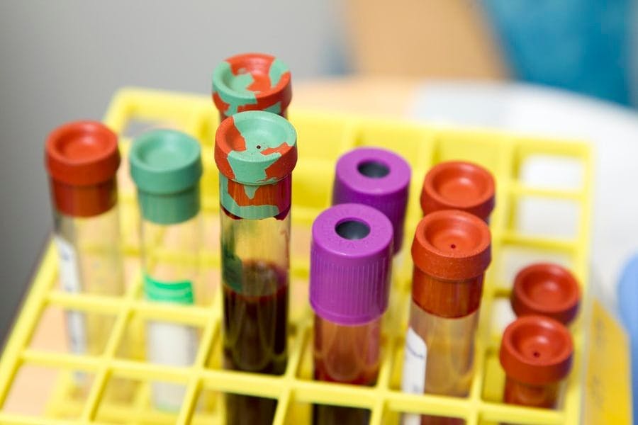 Blood Tests May Help Monitor SARS-CoV-2 Infection