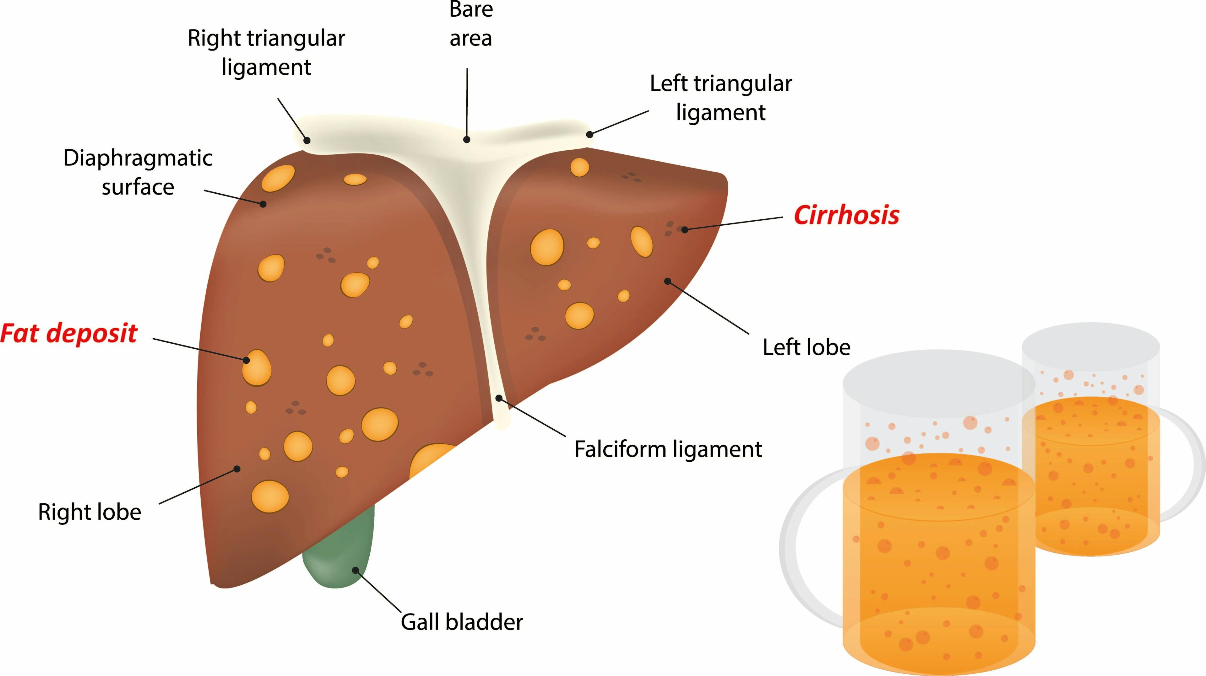 Identifying Causes and Effects of Alcohol-Related Liver Disease