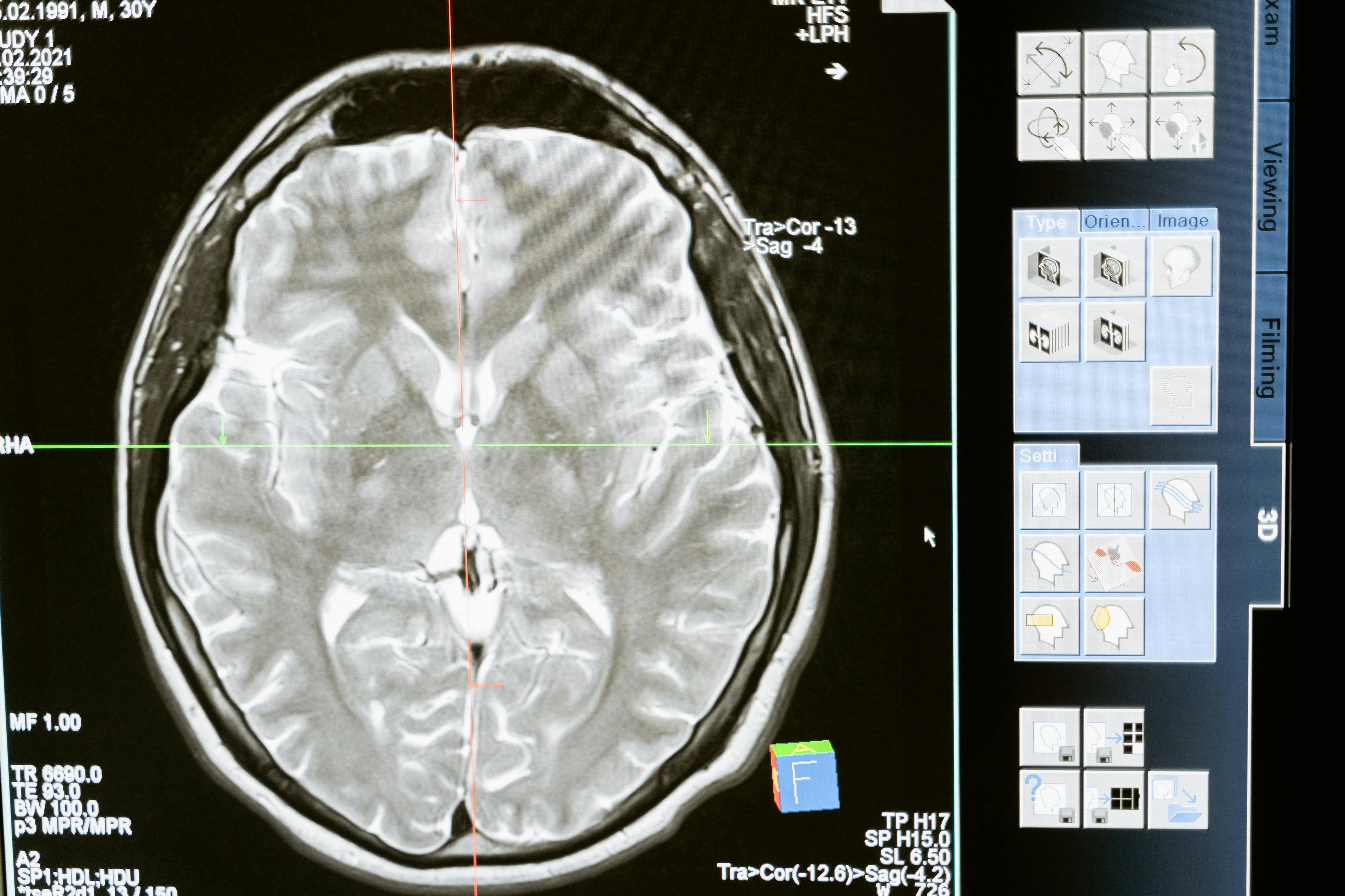 Ischemic Stroke, Other Neurological Problems: What’s COVID-19 Got to Do With It?