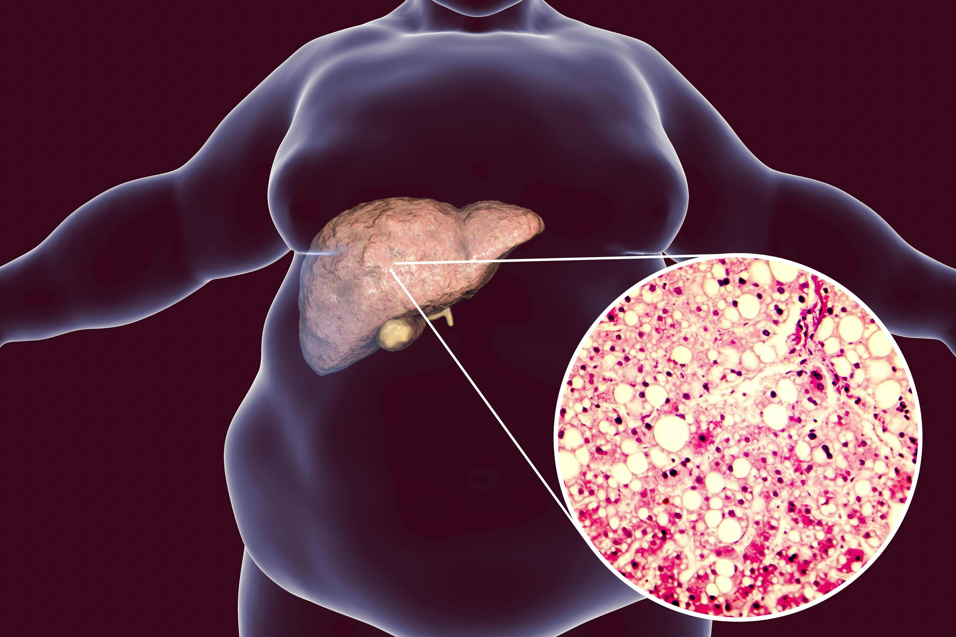 This finding, in addition to published clinical data, suggests VEGF-B signaling may play a significant role in human non-alcoholic fatty liver disease pathophysiology. 