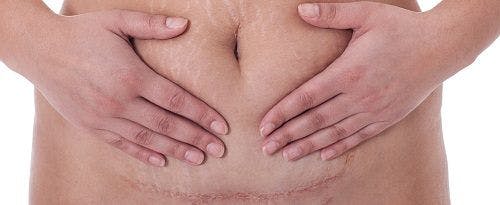Post-Cesarean-Section Antibiotics May Prevent SSIs in Obese Women