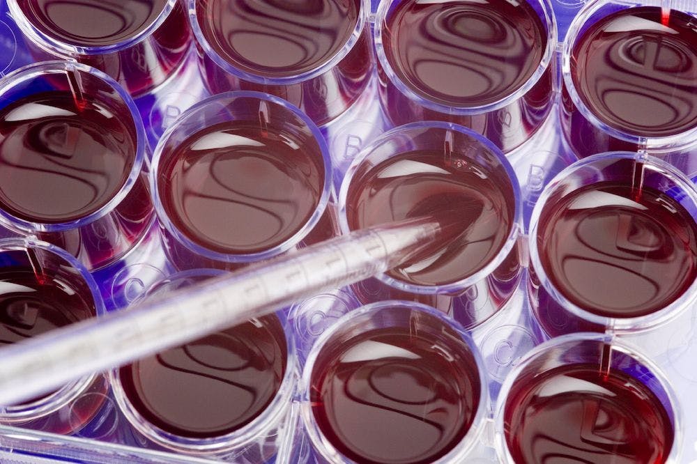 Stem Cell Transplant Found to Lower HIV Reservoir