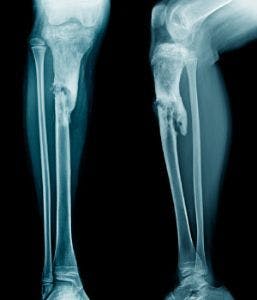 Potential Two-Dose Dalbavancin Treatment for Osteomyelitis