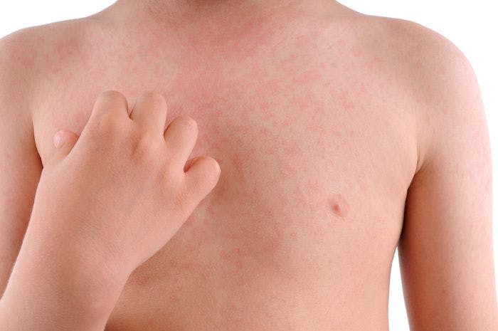 Could Flu Be Causing Hives?
