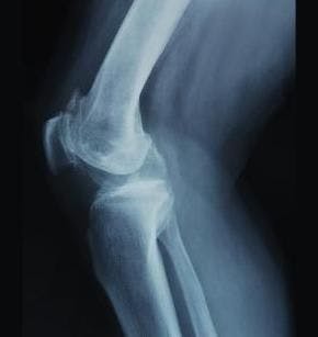 Surgical Duration, Patient-Specific Factors Heighten Infection Risk in Knee Replacement