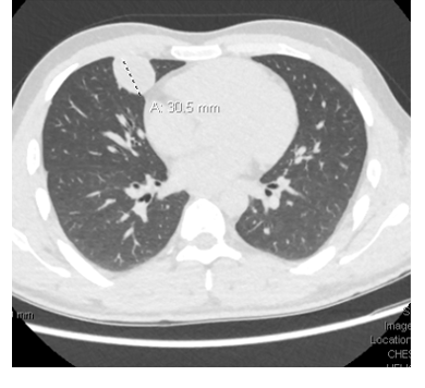 Ruptured Echinococcal Pulmonary Cyst