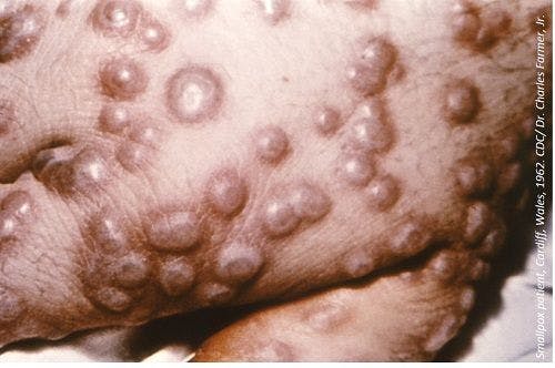 Smallpox Treatment Receives Orphan Drug Designation From FDA