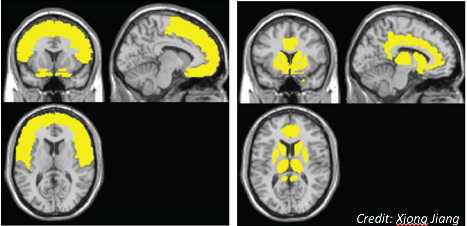 Model Identifies Brain Regions Linked With HIV-Associated Neurocognitive Disorders