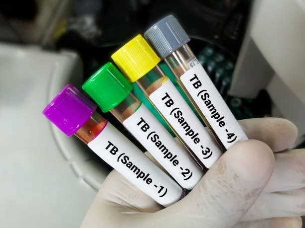 4 samples of TB testing.

Image Credits: Unsplash 