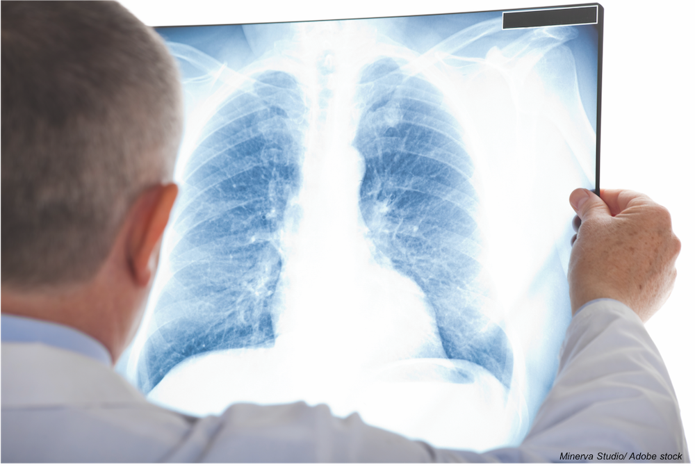 Chest X-Rays Show Racial Disparity in COVID-19 Severity