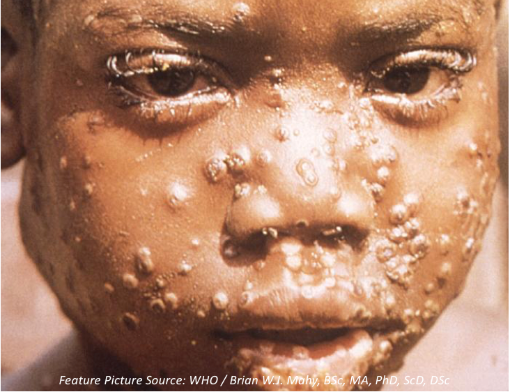 After 4 Decades, A Rare Disease Has Re-Emerged in Nigeria