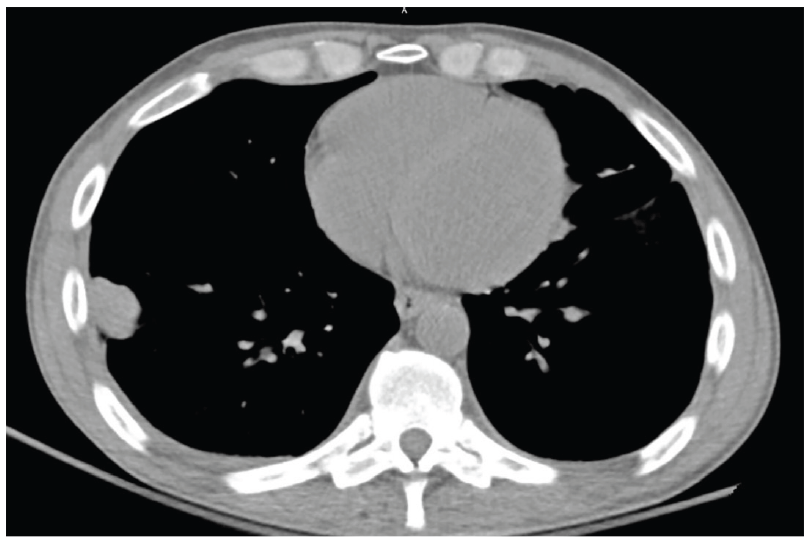 Pulmonary Coinfection With C neoformans and C immitis: A Novel Fungal Cohabitation