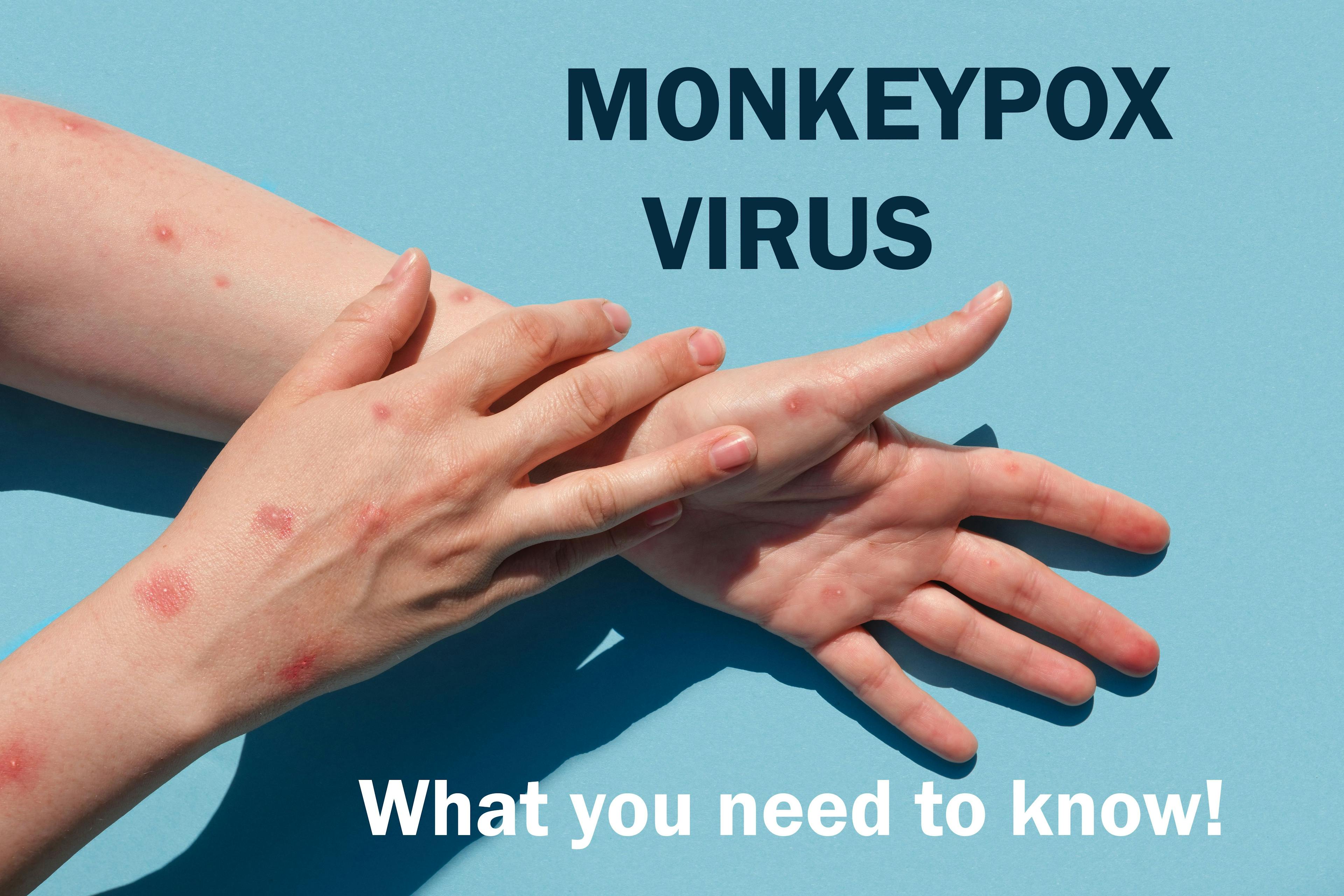 New precautions detail what clinicians treating suspected or confirmed monkeypox cases need to know.